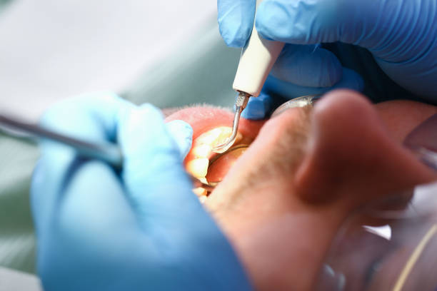 Best Chipped Tooth Repair Near Me  in Uniontown, OH
